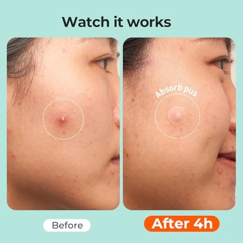 TKTK 443 Count Pimple Patches for Face, Hydrocolloid Acne Patch Bulk, Acne Stickers for Covering Cheeks, Forehead, Chin Blemishes Zit Breakouts for All Skin Types (Dots, Strip, Contoured 5 Sizes) — view 5