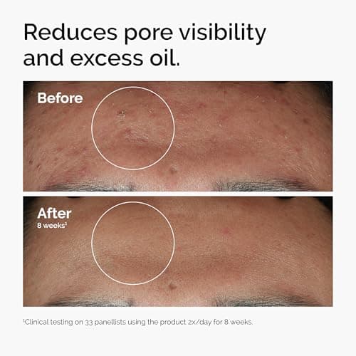 The Ordinary Niacinamide 10% + Zinc 1%, Smoothing Serum for Blemish-Prone Skin, 1 Fl Oz