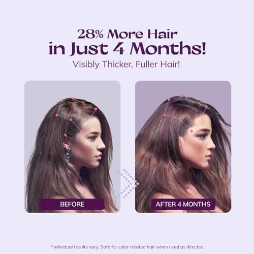 Women's 5% Minoxidil Spray for Hair Growth: RootStim Extra Strength Minoxidil with Rosemary & Biotin for Thinning Hair Regrowth and Fuller Hair – 2.01 Fl Oz — view 3