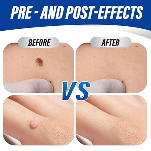 OSNOIA Extra Strength Wart Remover Liquid with 17% Salicylic Acid, Fast Acting Treatment for Plantar & Common Warts, Corn Remover for Feet and Toes (15ml, Warts Remover (1 P)) — view 4