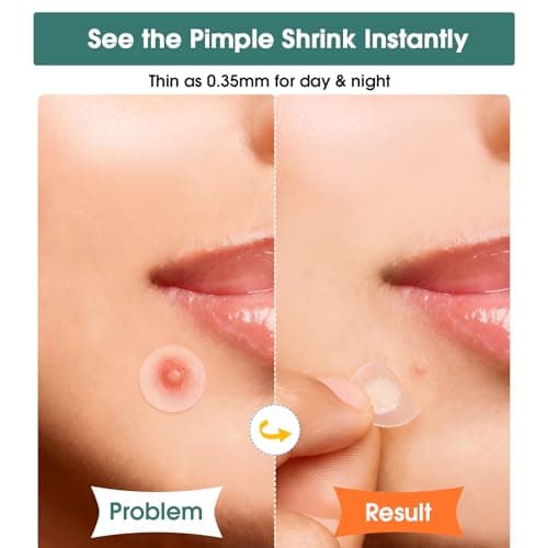 524 Pimple Patches for Face, Hydrocolloid Acne Patches for Large Breakouts & Clusters Coverage, Fast Absorbing with Salicylic Acid & Tea Tree Oil, 5 Shapes & 10 Sizes for Face, Nose & Body — view 3