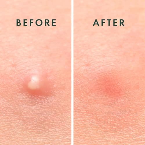 Rael Miracle Invisible Spot Cover - Absorbing Cover, Hydrocolloid Patch, Korean Skin Care, Facial Stickers, 2 Sizes (96 Count) — view 4