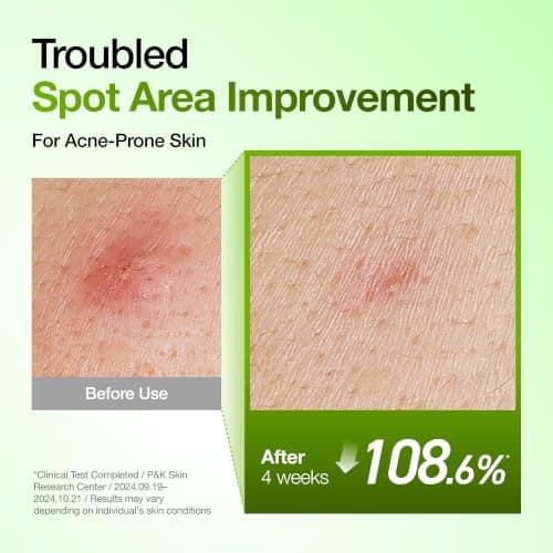 Anua Azelaic Acid 10 Hyaluron Redness Soothing Serum, Facial Serum for Blemish-Prone & Oily-Prone Skin, Lightweight & Hydrating Blemish Care, Hyaluronic Acid, Korean Skincare, 1.01 fl oz. — view 4