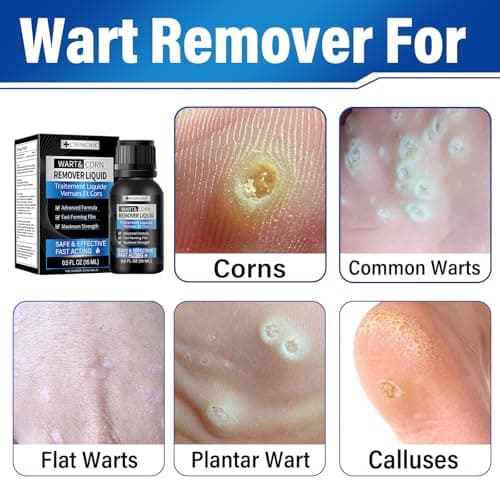 OSNOIA Extra Strength Wart Remover Liquid with 17% Salicylic Acid, Fast Acting Treatment for Plantar & Common Warts, Corn Remover for Feet and Toes (15ml, Warts Remover (1 P)) — view 2