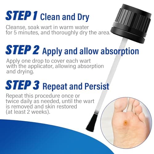 OSNOIA Extra Strength Wart Remover Liquid with 17% Salicylic Acid, Fast Acting Treatment for Plantar & Common Warts, Corn Remover for Feet and Toes (15ml, Warts Remover (1 P)) — view 3