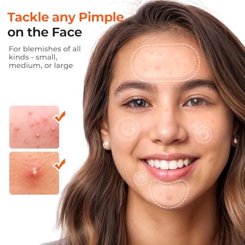 TKTK 443 Count Pimple Patches for Face, Hydrocolloid Acne Patch Bulk, Acne Stickers for Covering Cheeks, Forehead, Chin Blemishes Zit Breakouts for All Skin Types (Dots, Strip, Contoured 5 Sizes) — view 2