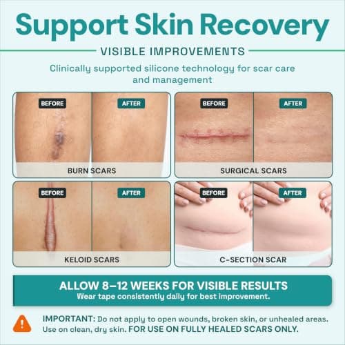 Scar Tape for Scar Treatment, Scar Patches, Silicone Scar Sheets Scar Patches for Surgical Scars, C Section Scar Silicone Strips, Silicone Tape Medical Grade Aloe Vera Scar Tape, for Face and Body — view 2