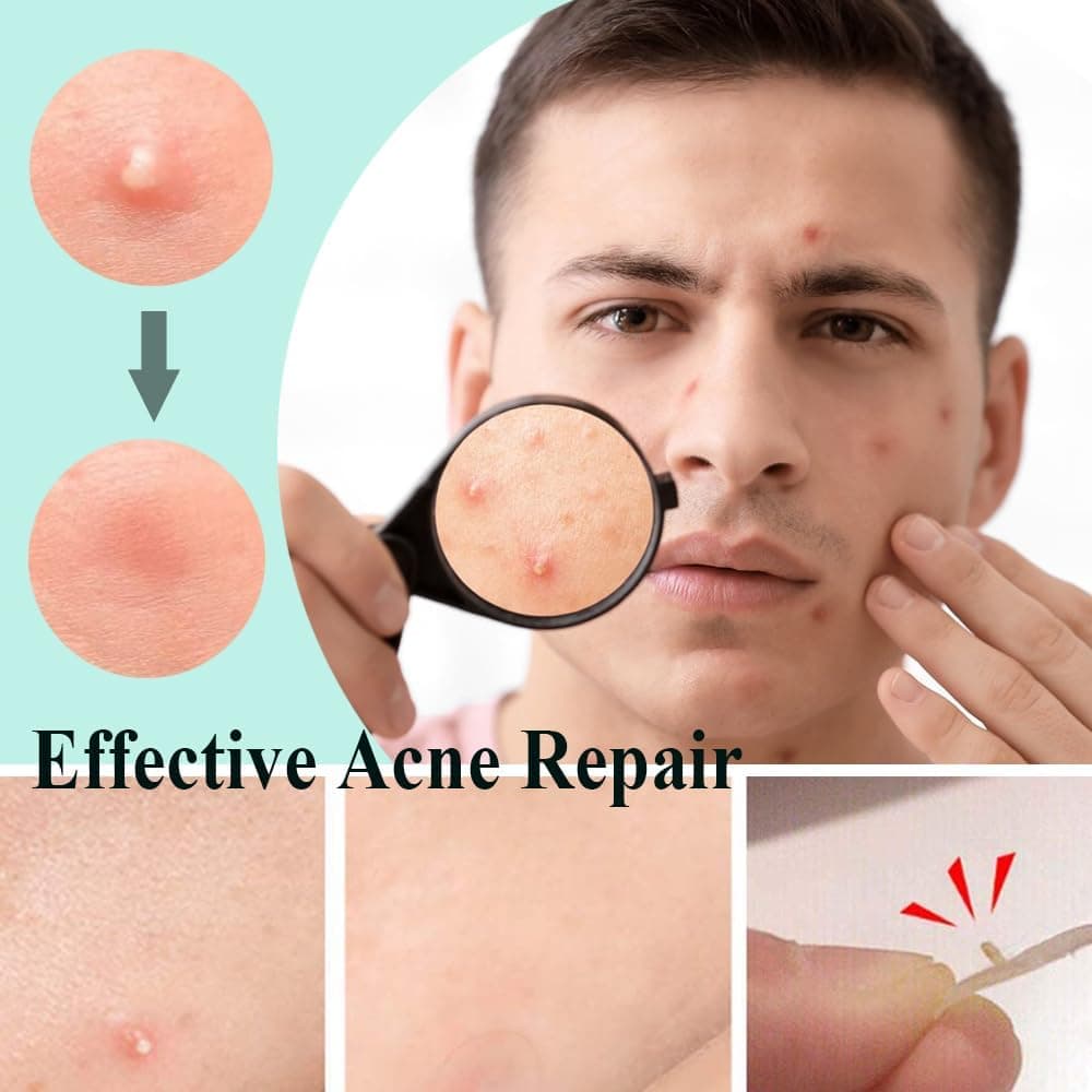 Zemolo 300 PCS Patches For Pimple,Pimple Patch Patches Acne Hydrocolloid Invisible Absorbent Cover,Day And Night Use In One,  — view 3