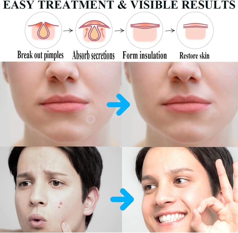 Zemolo 300 PCS Patches For Pimple,Pimple Patch Patches Acne Hydrocolloid Invisible Absorbent Cover,Day And Night Use In One,  — view 5