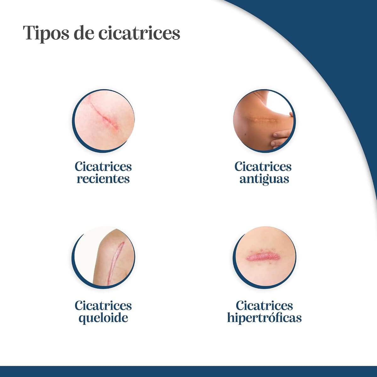 Trofolastin, Reductor de Cicatrices, Apósitos Adhesivos para Cicatrices Hipertróficas y Queloides, Quemaduras y Cortes, Tamaño 5x7,5cm, 5 Unidades — view 4