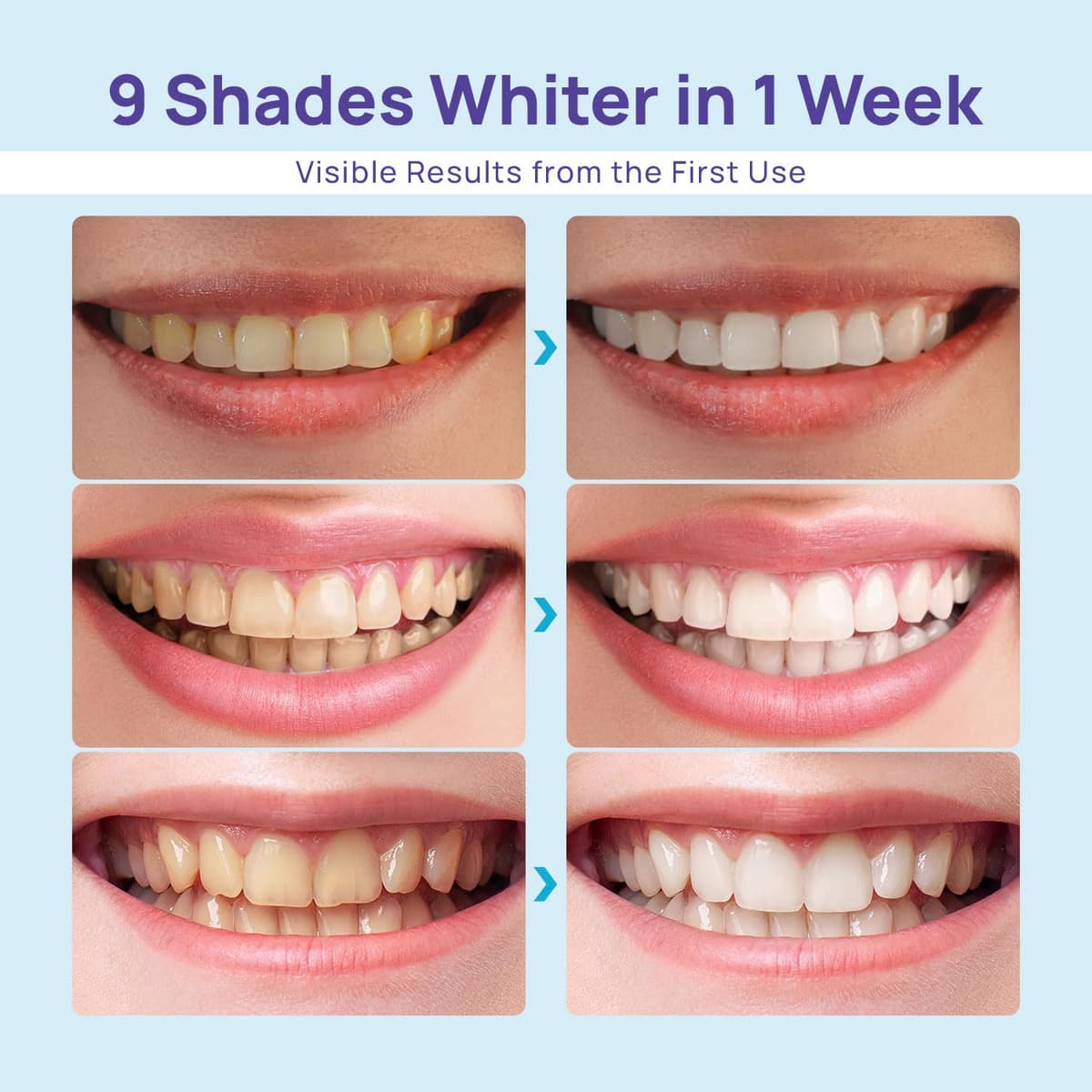 Teeth Whitening Kit — view 2