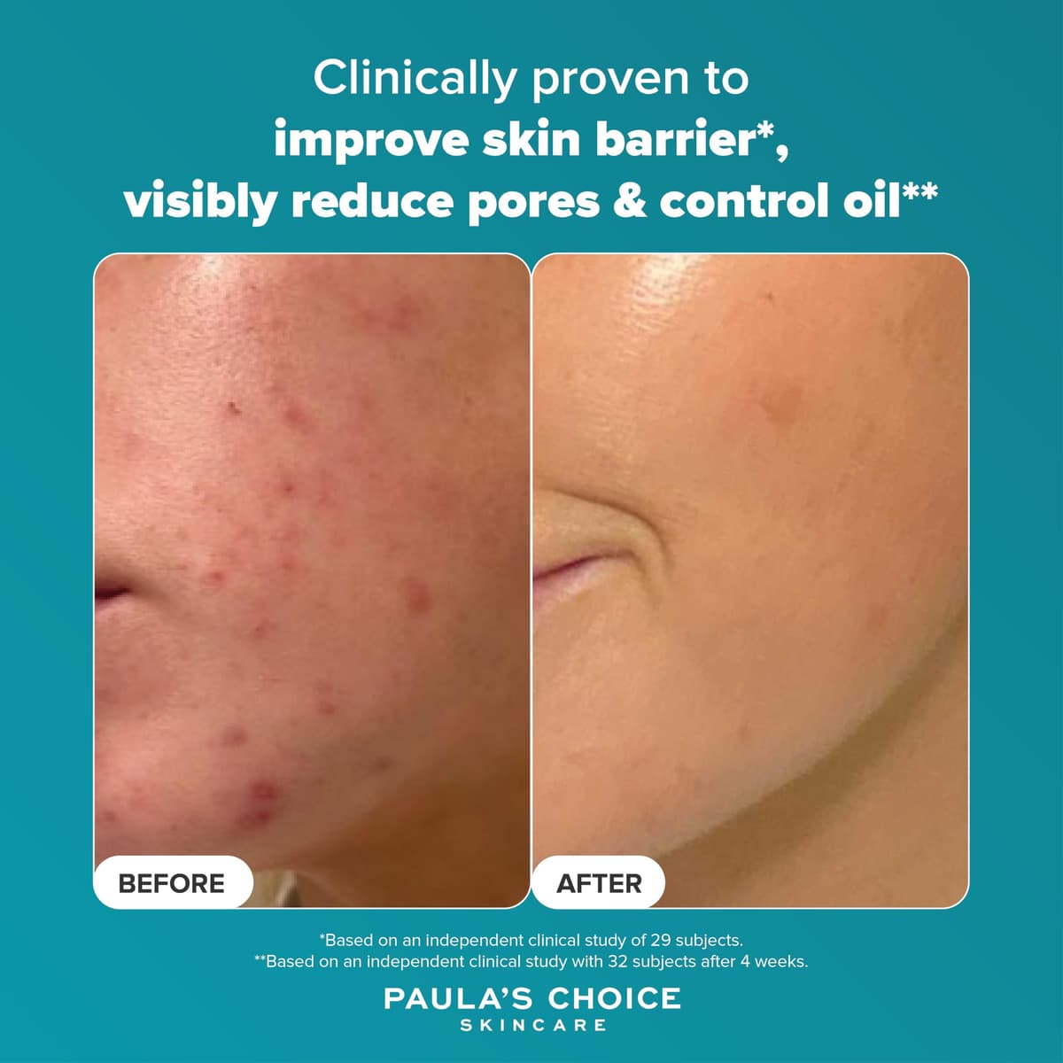 Paula's Choice SKIN PERFECTING 2% BHA Liquid Exfoliant - Face Exfoliating Peel Fights Blackheads & Enlarged Pores - for a Healthy Glow - with Salicylic Acid - Combination & Oily Skin - 30 ml — view 5