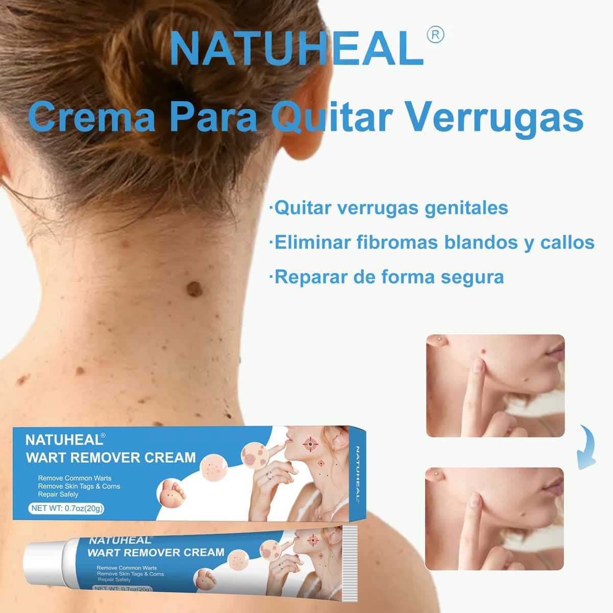 Crema para eliminar verrugas y acrocordones, kit para rostro y cuerpo, eliminación suave de verrugas plantares, comunes, callos y planas, 20 g — view 2