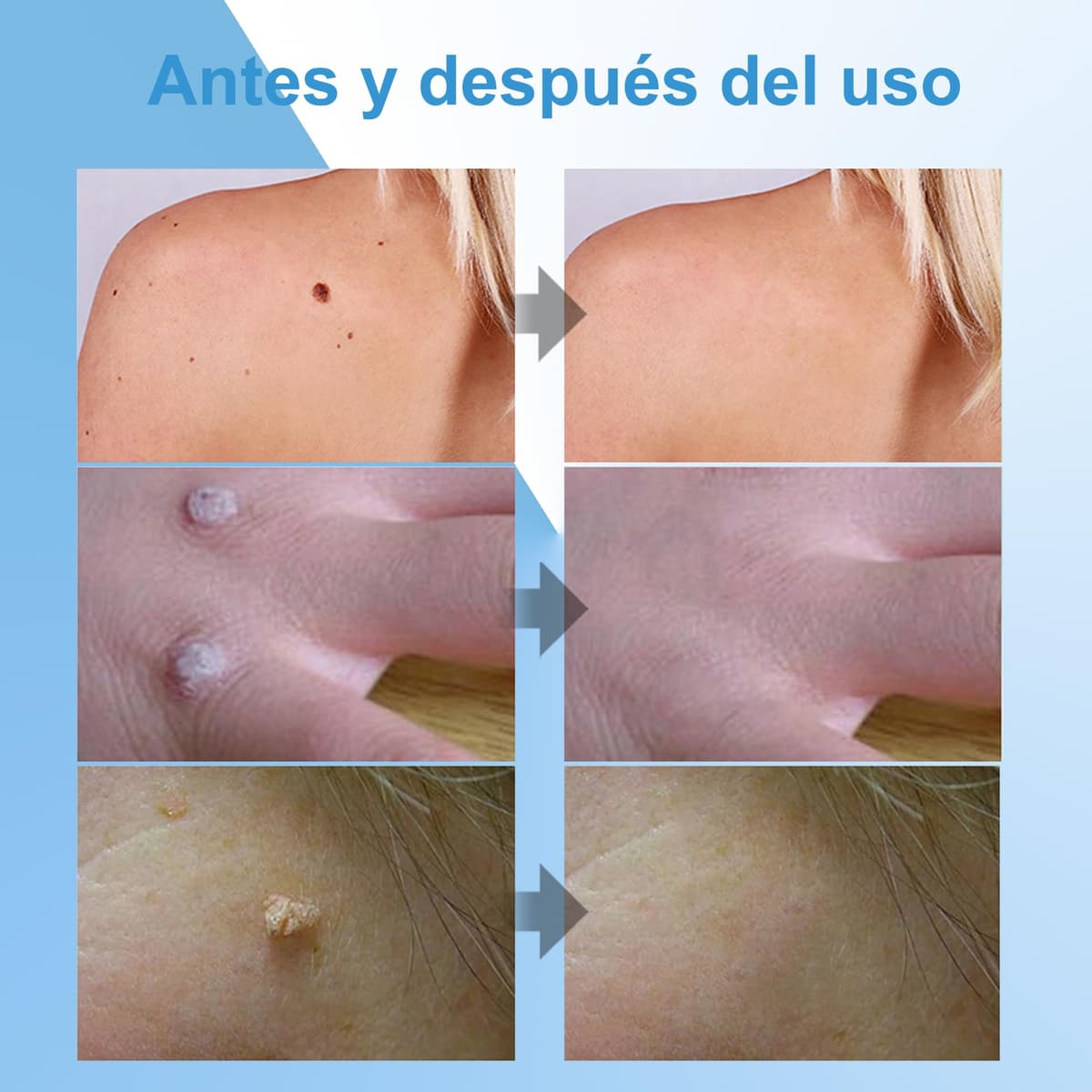 Crema para eliminar verrugas y acrocordones, kit para rostro y cuerpo, eliminación suave de verrugas plantares, comunes, callos y planas, 20 g — view 5