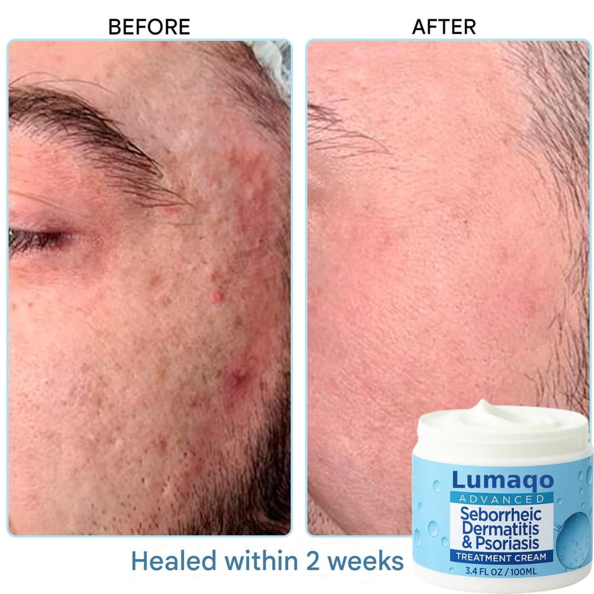 Lumaqo Crema Barba Dermatitis,Hidratación Natural,Fórmula Suave Para Pieles Sensibles Y Secas,Para Todo Tipo De Piel (1 Caja) — view 3