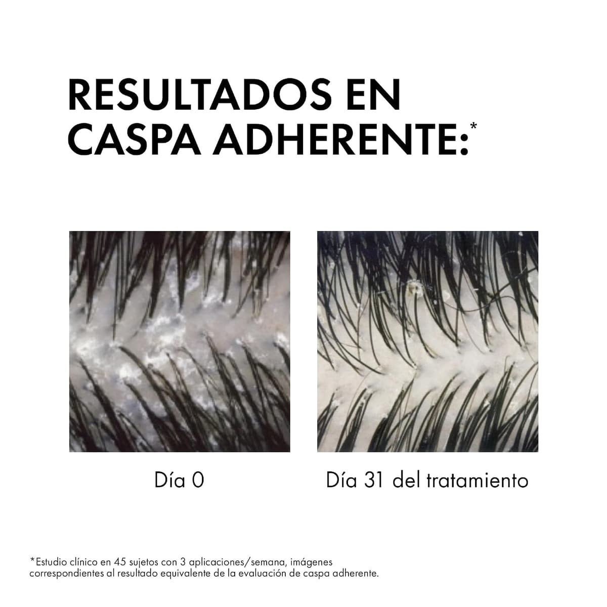 Vichy Champú Anticaspa, Cabellos Grasos, Elimina la Caspa y Reduce los Picores, Cuero Cabelludo Limpio y Sano, Doble Eficacia, Unisex, Dercos Technique, 390 ml — view 2