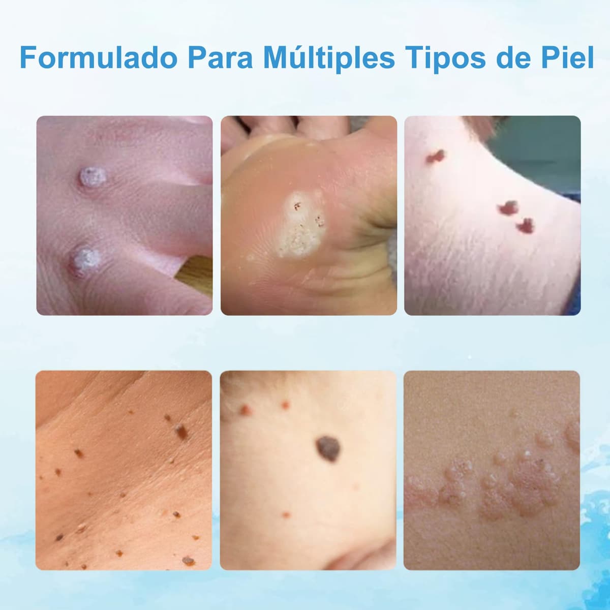 Crema para eliminar verrugas y acrocordones, kit para rostro y cuerpo, eliminación suave de verrugas plantares, comunes, callos y planas, 20 g — view 3