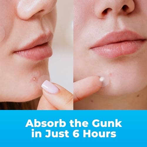 PatchRx Pimple Patches for Face (120 Patches), Hydrocolloid Pimple Patches - Pimple Patch Zit Patch and Pimple Stickers - Hydrocolloid Pimple Dots for Pimples - Zit Patches